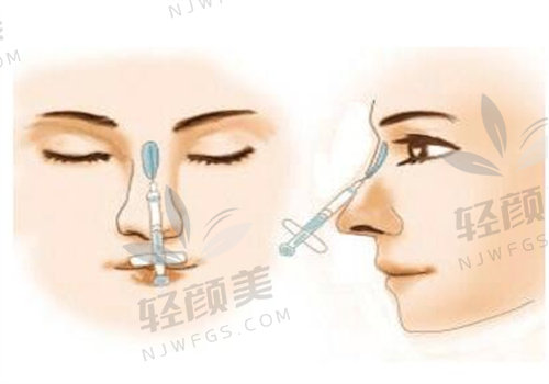 花15800找新疆威兹曼贾杰昌做鼻综合，术后效果惊艳，这次整形太值了！