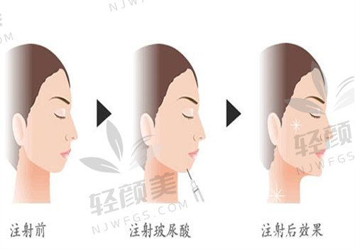 润百颜黑金玻尿酸怎么样？立体网状结构，强支撑塑形效果超惊艳！