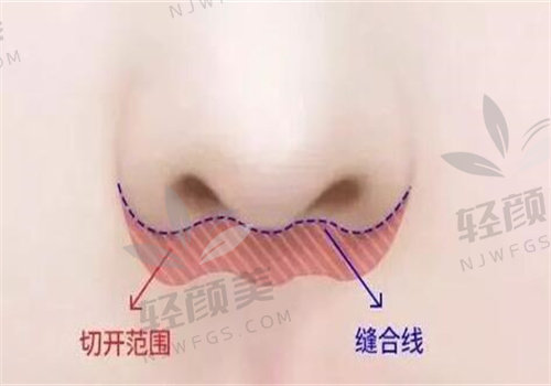 深圳福雅医疗做人中不留疤超自然，价格、方式、优势一次性了解清楚