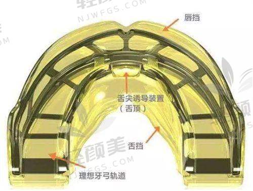 北京维乐口腔王峥做成人金属托槽进口矫正的技术优势