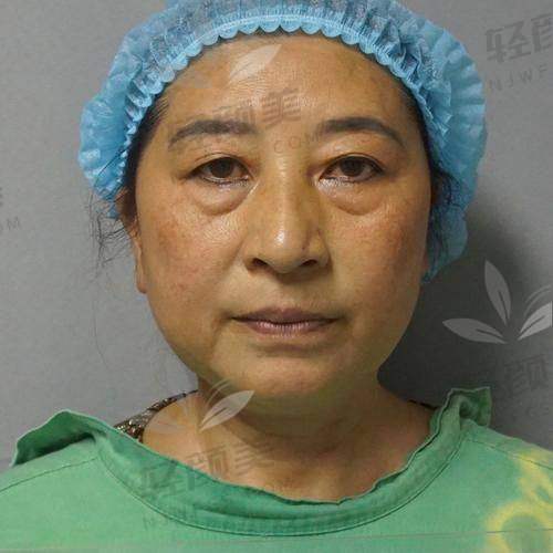 新疆威兹曼刘丽娜做眶隔脂肪释放的技术优势