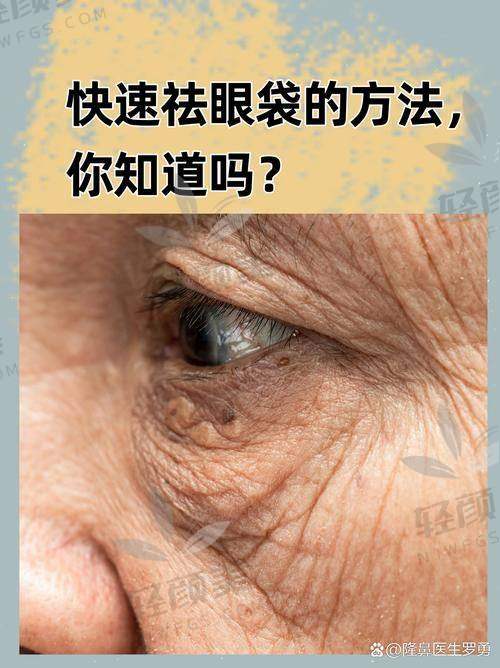 新疆威兹曼刘丽娜做眶隔脂肪释放的成功实例