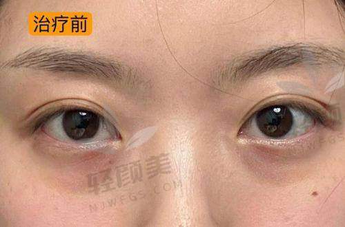 新疆威兹曼刘丽娜做眶隔脂肪释放的预约挂号方式