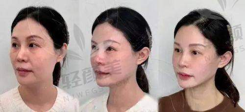 二、润百颜黑金玻尿酸适合打哪里？哪些部位更惊艳？