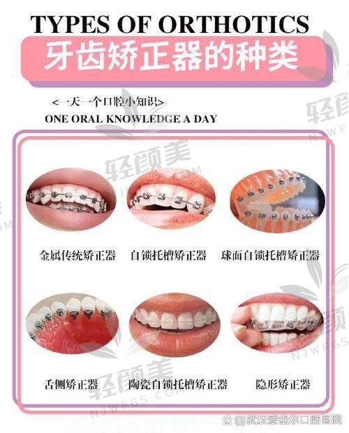 北京维乐口腔王峥做成人金属托槽进口矫正的成功实例