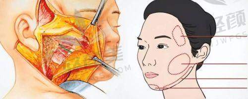 结尾总结:广州聂云飞医生在哪坐诊?技术怎么样?值得预约吗?