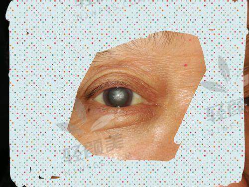 超全北京白内障手术价格表来袭，含各类晶体价格，助你轻松规划手术费用！