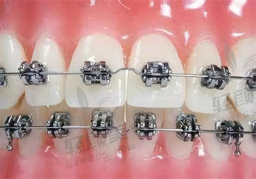 北京维乐口腔李梦思做成人金属托槽国产矫正21000元起,经验丰富成效优