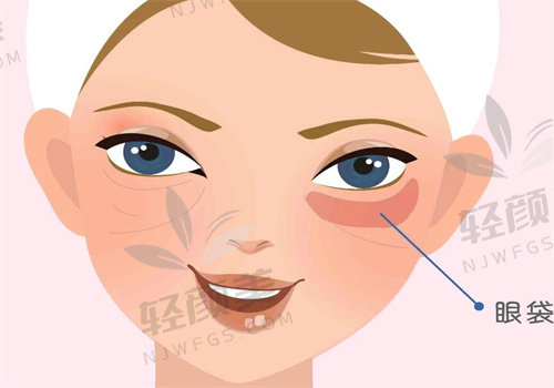 新疆威兹曼整形外科医院林仙保做内切祛眼袋7800元起,隐痕减龄效果好