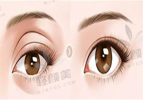 花6800元在新疆威兹曼找刘丽娜做微创三点定位双眼皮，效果惊艳超自然！