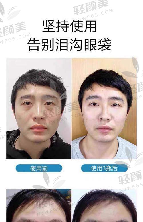 林仙保医生内切祛眼袋的成功实例