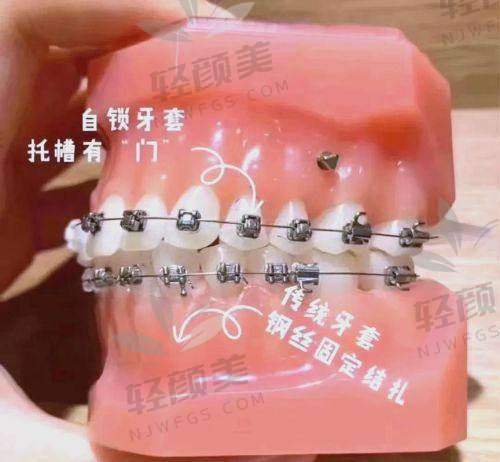 北京维乐口腔李梦思做成人金属托槽国产矫正的实例展示