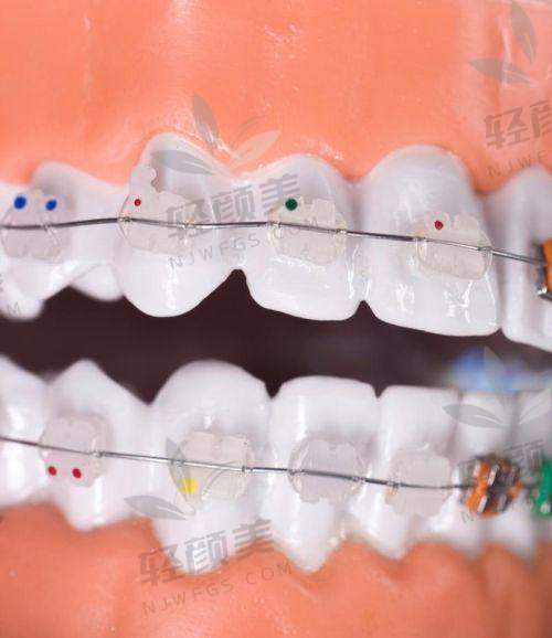 北京维乐口腔李梦思做成人金属托槽国产矫正的预约挂号方式