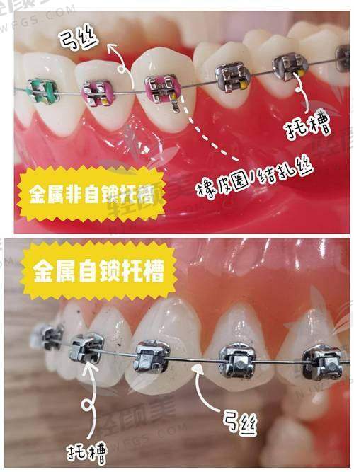 北京维乐口腔李梦思做成人金属托槽国产矫正的口碑评价