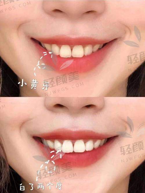 北京维乐口腔冷光美白预约挂号方式