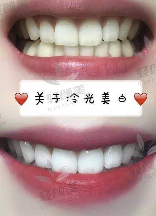北京维乐口腔冷光美白的口碑