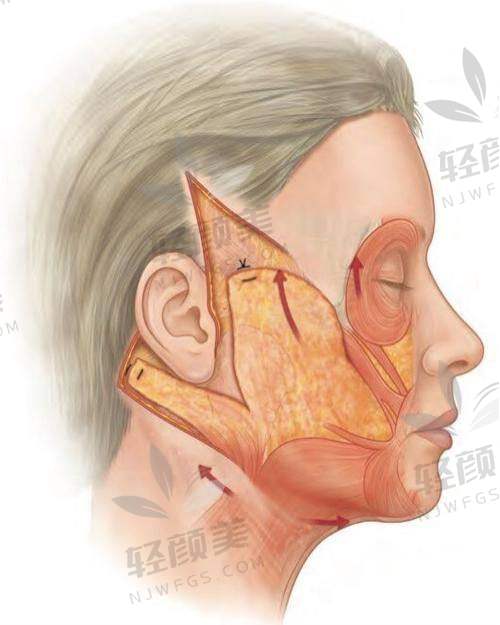 黄江泊医生做全方面部小拉皮的技术优势在哪里?