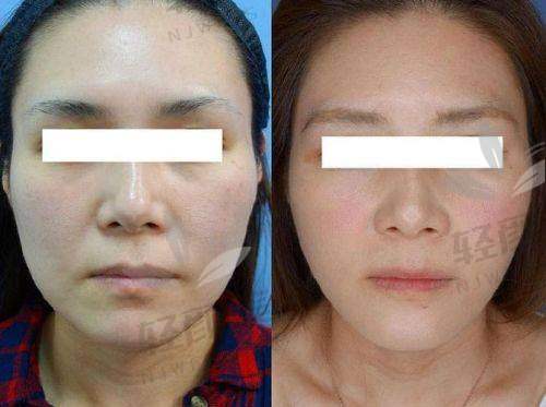 乌鲁木齐华美医院做全方面部小拉皮的医院优势有哪些?