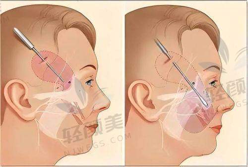 乌鲁木齐华美黄江泊做全方面部小拉皮的成功实例多吗?成效怎么样?