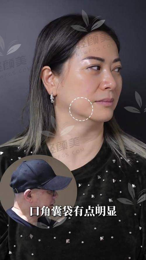 如何预约乌鲁木齐华美黄江泊做全方面部小拉皮手术?